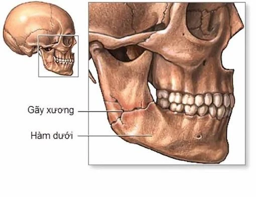 Gãy xương hàm dưới do tai nạn giao thông