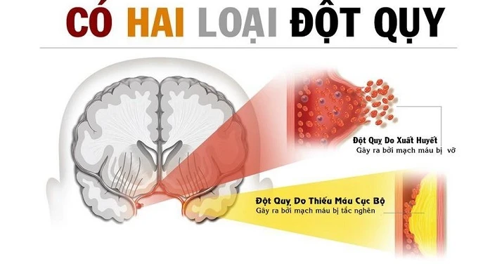 Dẫn lưu bạch huyết – phương pháp dự phòng đột quỵ hiệu quả nhất