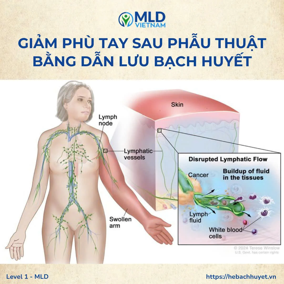 MLD là tiêu chuẩn vàng trong điều trị phù tay sau nạo vét hạch